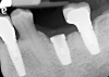 (3.) Periapical radiograph showing the extent and location of the prosthetic screw fragment.