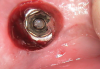 (4.) View of the screw fragment after the fixture was uncovered with a biopsy punch.