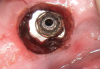 (7.) Occlusal view of the fixture following removal of the screw fragment and final cleaning.