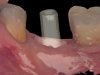 (8.) The arch was scanned with a scan body in place to fabricate a new screw-retained, implant supported restoration.