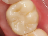 (10.) Immediate posttreatment occlusal view of the final restoration in place with the screw channel sealed with a universal composite.