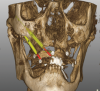 (2.) Treatment planning view of the implant positions in a quad zygoma case.