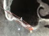 (5.) Treatment planning view of right-side zygomatic implant to be placed with the extramaxilliary approach.