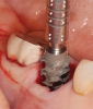 (1.) This series of clinical images illustrates the use of an implant with well-defi ned
threads that improve lateral bone engagement. In a multirooted extraction socket where there are large voids, this can help to achieve initial implant stability.