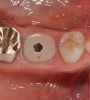 (4.) This series of clinical images illustrates the use of an implant with well-defi ned
threads that improve lateral bone engagement. In a multirooted extraction socket where there are large voids, this can help to achieve initial implant stability.