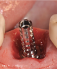 (9.) Chairside custom healing abutment fabrication in progress using a temporary abutment.