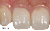 (18.) Postoperative view 3 months after provisional restoration. Note the ideal tissue anatomy that was created through correct implant positioning and immediate transmucosal guidance.