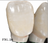 (28.) Provisional crown fabricated
chairside using the facial aspect of an extracted tooth fused to a transitional abutment with composite. Attention to contouring is centered on the immediate
subgingival contour to support the marginal gingiva with undercontouring of the temporary abutment to the head of the implant.