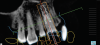 (11.) Restoratively driven anterior implant planning views. Considerations include spac-ing relative to adjacent roots (minimally 1.5 mm), facial-palatal orientation to engage apical and palatal bone and avoid the nasopalatine duct, and selection of an implant diameter that will allow for facial bone grafting or partial extraction therapy.