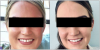 Fig 1. Left panel: Patient’s perception of her malocclusion. Right panel: Patient’s final photograph after the patient’s chief concern was addressed through clear aligner therapy via a hybrid partner network. Fig 1. Left panel: Patient’s perception of her malocclusion. Right panel: Patient’s final photograph after the patient’s chief concern was addressed through clear aligner therapy via a hybrid partner network.