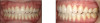 Fig 3. Left panel: Patient’s perception of smile line after treatment. Right panel: Clinician’s perception of malocclusion after treatment: a less-than-ideal treatment result.