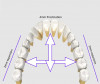 Fig 5. Expansion of posterior region of 2 mm on each side, and anterior proclination of 4 mm.