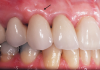 (1.) The gingival marginal tissue over the facial aspect of an ovate pontic with an 'egg in the nest' design is commonly rolled rather than knife edged, which can result in a shadow and give away the presence of the pontic.