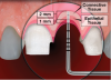 (4.) Depiction of bone sounding revealing a 1-mm deep ovate pontic site with 2 mm of tissue remaining between the base of the site and the alveolar bone.