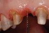 (12.) Bone sounding was performed to confirm that there was at least 2 mm from the base of the pontic sites to the alveolar bone.