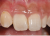 (17.) Postoperative view 1 month after provisional restoration.