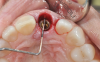 (20.) Immediate implant placement. The residual bone defect, which measures approxi-mately 3 mm, was intentionally developed by planning the use of a suitable implant diameter.