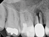 (1.) A radiograph of a root fracture associated with a threaded post, cone-beam computed tomography views of a perforation associated with a post, and a radiograph demonstrating evidence of apical leakage associated with posts, respectively.