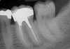 (5.) Radiographs of teeth treated with prefabricated and custom cast posts, respectively.