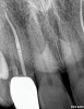 (7.) Pretreatment and posttreatment radiographs of an endodontically treated anterior tooth with minimal remaining coronal tooth structure that benefited from a post, a core, and full-coverage restorative care.