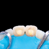 (2.) The pulp chambers of a patient’s maxillary central incisors being accessed for the placement of sodium perborate for the walking bleach technique.