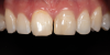 (4.) Pretreatment and posttreatment close-up photographs of maxillary central incisors treated with internal bleaching and direct composite veneers.