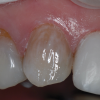 (7.) A pink opaquer was placed prior to the placement of composite.