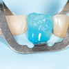 (3.) A 37% phosphoric acid etchant is applied to the labial surface of an incisor as part of a total-etch approach because only the enamel is exposed.