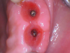 (3.) Occlusal view of the emergence profile and gingival architecture after adequate healing.