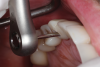 (7.) A specific angulated screw channel ratchet and driver being used to final torque the tooth No. 6 restoration into place. Separate instruments were used for the straight channel restoration.