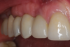 (8.) Close-up retracted buccal view of the final restorations in place.