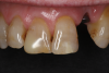 (9.) Preoperative maxillary retracted view of missing tooth No. 10 and failing restorations on teeth Nos. 7 through 9.