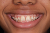 (1.) Pretreatment smile, left lateral smile, and right lateral smile photographs, respectively, showing the patient’s peg-shaped lateral incisors.