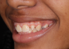 (2.) Pretreatment smile, left lateral smile, and right lateral smile photographs, respectively, showing the patient’s peg-shaped lateral incisors.
