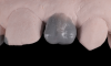 (6.) Close-up views of the full wax-up of teeth Nos.7 and 10, respectively.
