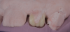 (10.) Putty guide for incisal edge verification on teeth Nos. 7 and 10, respectively.