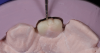 (11.) Putty guide for occlusal verification on teeth Nos. 7 and 10, respectively.