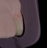 (14.) Putty guide for sagittal verification on teeth Nos. 7 and 10, respectively.