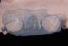 (16.) Silicone index of the full wax-up of teeth Nos. 7 and 10, respectively, on the model.