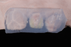 (18.) Silicone index of the cutback wax-up of teeth Nos. 7 and 10, respectively, on the model.