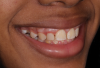 (34.) Posttreatment smile, left lateral smile, and right lateral smile photographs, respectively.