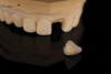 (7.) The composite was cured, and the tooth shell was snapped off of the model. Then, the stone inside of it and the composite flash at the margins were removed.