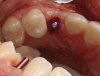 (11.) Conformation of the position and angulation of the initial osteotomy preparation of a patient who presented for replacement of the maxillary left canine.