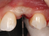 (13.) The appropriateness of the apical depth of the implant head was confirmed.