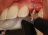 (15.) The primary stability of the implant was assessed using RFA.