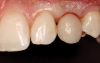 (28.) The provisional was designed to partially support the gingiva while allowing room for the papillae and gingival zenith to migrate incisally.
