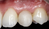 (32.) Smile, retracted, and close-up views of the provisional restoration at the 4-month follow-up appointment to assess the development of tissue volume and contours. Note that most of the open gingival embrasures have filled with papillae and that the gingival zenith exhibits excessive volume.