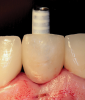 (39.) The composite tooth shell was modified to fit around the abutment, positioned intraorally, and bonded to the abutment with flowable composite in the incisal half.