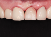 (44.) The provisional restoration was placed back on the implant and tightened to 15 Ncm while applying counter torque. Note that the papillae are partially supported without pressure and that the gingival embrasures are slightly open to allow incisal migration of the papillae during the integration and maturation phase.
