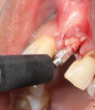 (47.) The primary stability of the implant was confirmed to be sufficient for immediate loading.